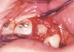 Fig. 9 : Extraction de la latérale et dégagement de la couronne de la canine.