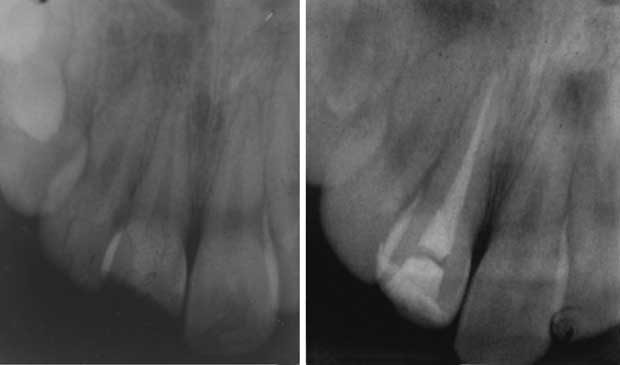 Radiographie rétro-alvéolaire en pré opératoire  et en post opératoire.