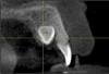 Relation entre l'inclusion des canines maxillaires et la résorption radiculaire des dents adjacentes dans une population orthodontique tunisienne : Etude transversale analytique