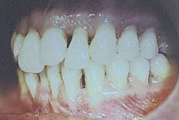 Fig.2 : c - occlusion latérale 