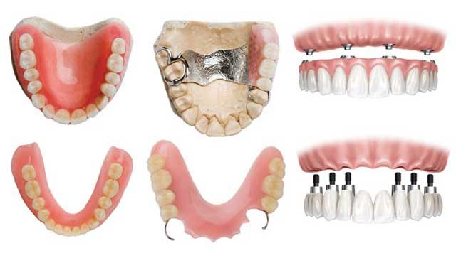 Types de prothèses dentaires