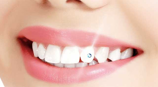 Les bijoux dentaires