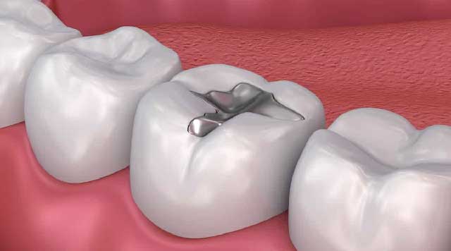 Curtage /Plombage Les 6 dent - Cabinet Dentaire Amara