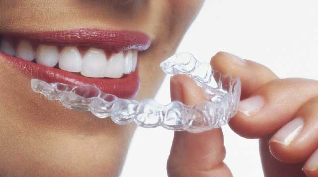 Aligneurs invisibles pour les dents - Ma santé bucco-dentaire